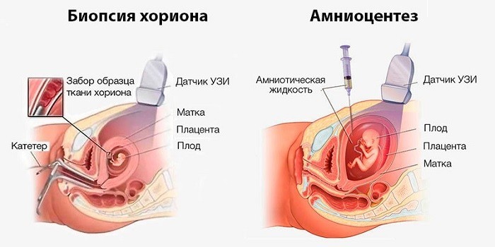 Проведение биопсии хориона и амниоцентеза 