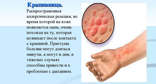 Проявления крапивницы
