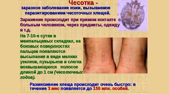 Признаки заражения чесоткой
