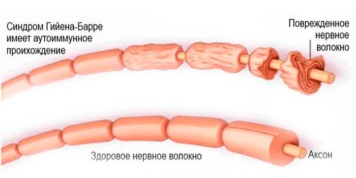 Повреждение нервного волокна