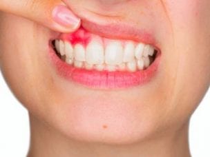 Киста на десне - причины и симптомы образования, методы лечения