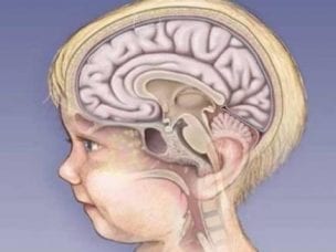 Менингит у новорожденных - причины, симптомы и последствия