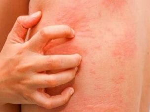 Туберкулез кожи - симптомы и причины заболевания, диагностика, методы лечения, профилактика