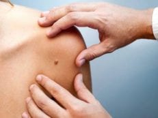 Злокачественные родинки — симптомы, методы диагностики и лечения