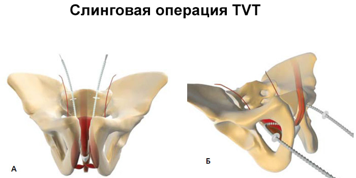 Суть слинговой операции