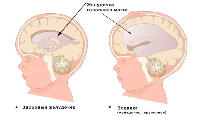 Проявления гидроцефалии