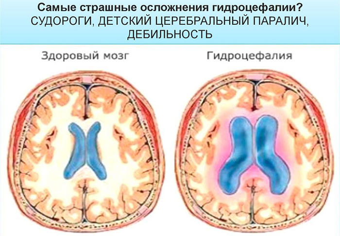 Осложнения гидроцефалии