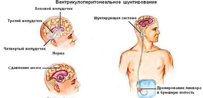 Установка шунтирующей системы